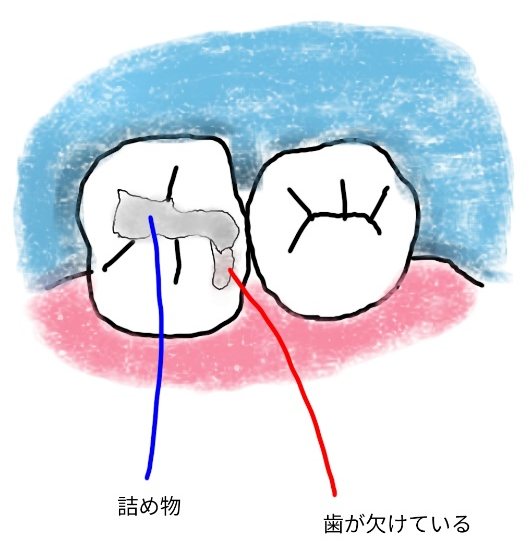 詰め物・被せ物の縁が欠けている