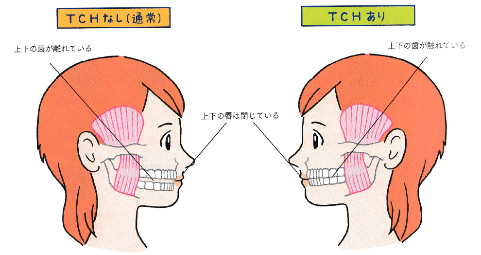 上下接触歯列癖をご存じですか？